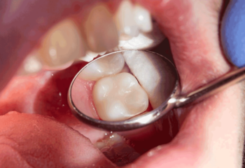 Composite Tooth Filling