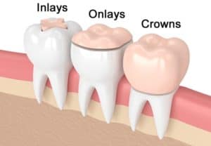 Dental Inlay Onlay Crown Graphic