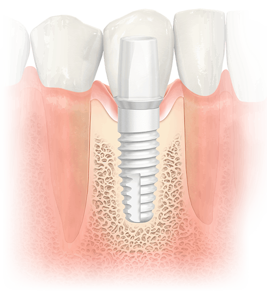 Are Dental Implants Worth The Investment?
