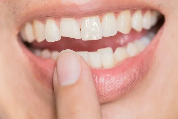 Repairing A Damaged or Chipped Tooth